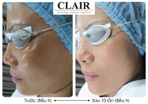 Clair Clinic, Trẻ hóa da, Nâng cơ mặt