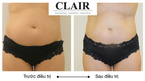 Clair Clinic, Trẻ hóa da, Nâng cơ mặt