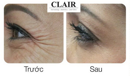 Trung tâm thẩm mỹ công nghệ cao Clair, Thẩm mỹ Clair, Clair khuyến mãi, làm đẹp