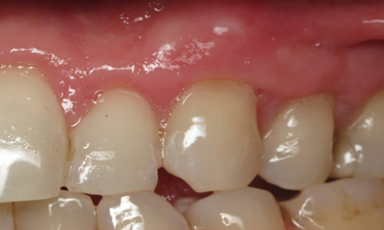 Những triệu chứng ban đầu của bệnh ung thư nướu răng