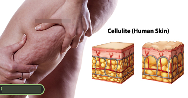 Cellulite - tình trạng da sần vỏ cam và cách chữa trị