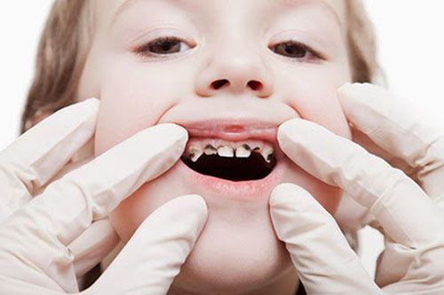 Phòng chống sâu răng ở trẻ nhỏ, Sâu răng, Ngừa sâu răng cho trẻ