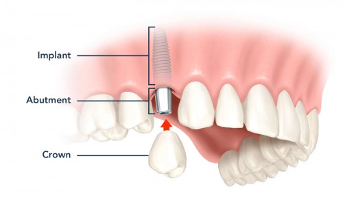 Nha Khoa Đông Nam, cấy ghép răng Impalnt, Chăm sóc răng