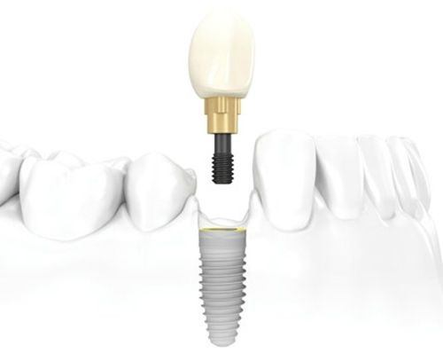 Nha Khoa Đông Nam, cấy ghép Implant, Trồng răng
