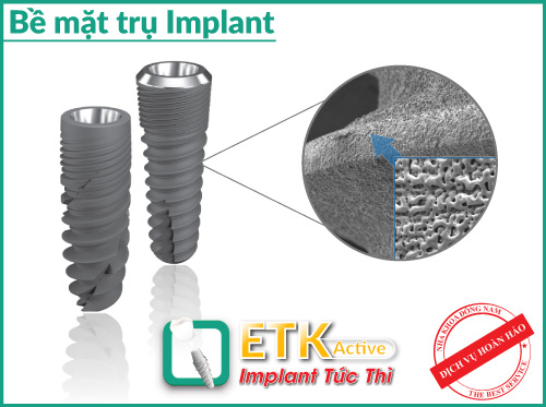 Nha Khoa Đông Nam, cấy ghép Implant, Trồng răng