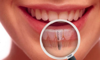 trồng răng Implant, Nha Khoa Đông Nam, Phòng khám răng uy tín