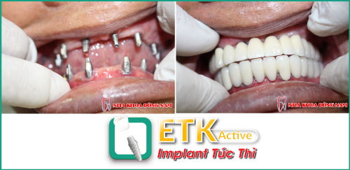 cấy ghép răng ETK Active, Nha Khoa Đông Nam, cấy ghép răng Implant 