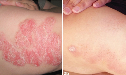 điều trị bệnh vảy nến, phòng khám chuyên khoa Dr. Michaels Psoriasis & Skin Clinic