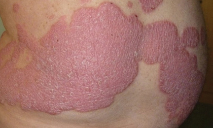 điều trị bệnh vảy nến, phòng khám chuyên khoa Dr. Michaels Psoriasis & Skin Clinic