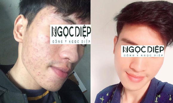 trị mụn, trị mụ bằng phương pháp đông y, Ngọc Diệp Beauty
