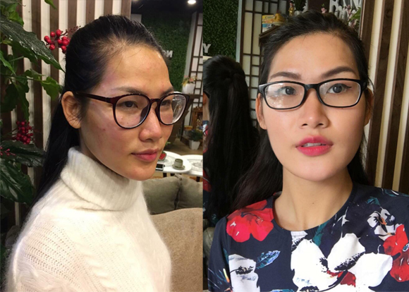 trị mụn, trị mụ bằng phương pháp đông y, Ngọc Diệp Beauty