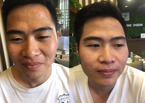 trị mụn, trị mụ bằng phương pháp đông y, Ngọc Diệp Beauty