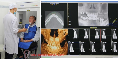 Nha khoa đông nam, cấy ghép Implant, trồng răng Implant