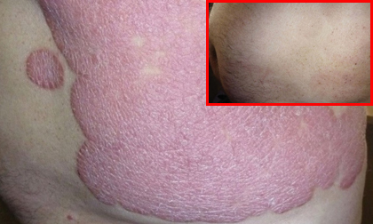 điều trị bệnh vảy nến, phòng khám chuyên khoa Dr. Michaels Psoriasis & Skin Clinic