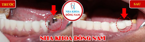 trồng răng Implant, Nha Khoa Đông Nam, Phòng khám răng uy tín