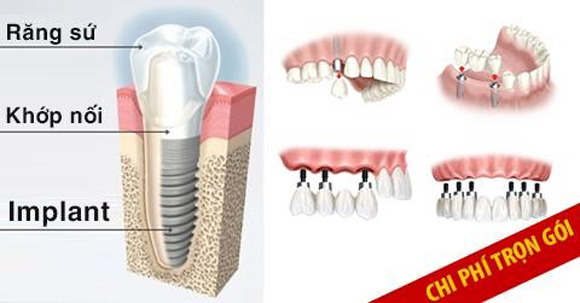 trồng răng Implant, Nha Khoa Đông Nam, Phòng khám răng uy tín
