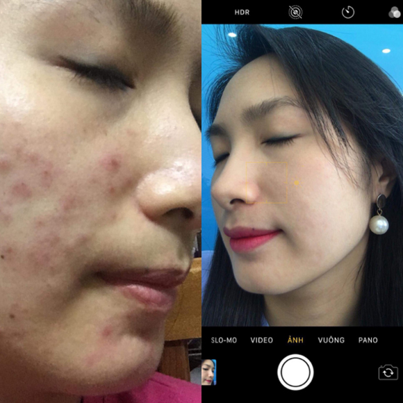 Đông y ngọc sâm, Mỹ phẩm Ngọc Sâm, Trị mụn bằng đông y