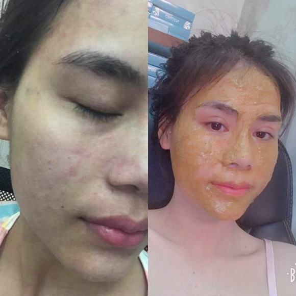 Đông y ngọc sâm, Mỹ phẩm Ngọc Sâm, Trị mụn bằng đông y