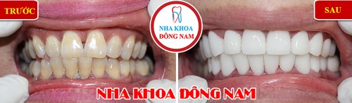 Dán răng sứ, Nha Khoa Đông Nam, Bọc răng thẩm mỹ