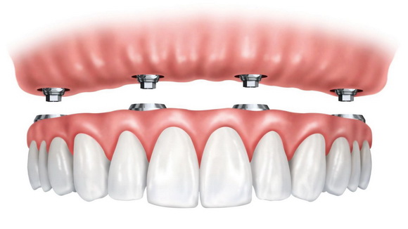 Nha khoa Đông Nam, phục hình răng nguyên hàm, Cấy ghép implant