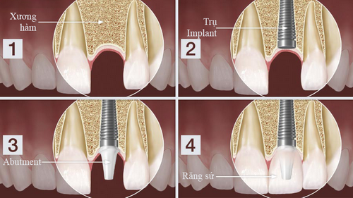 Nha Khoa Đông Nam, Trồng răng sứ, Cấy ghép Implant