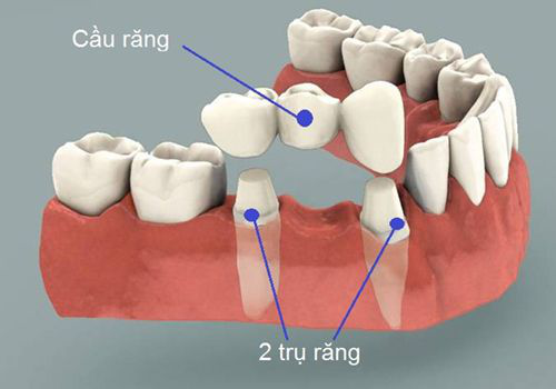 Làm Cầu Răng Sứ, nha khoa đông nam, răng giả