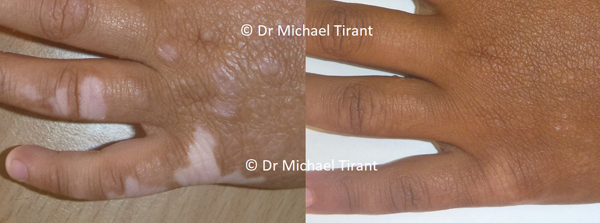 Bệnh bạch biến, thảo dược Vitilinex, Phòng khám Dr. Michaels Psoriasis & Skin Clinic