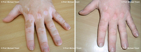 Bệnh bạch biến, Dr. Michaels Psoriasis & Skin Clinic, Phương pháp Dr. Michaels