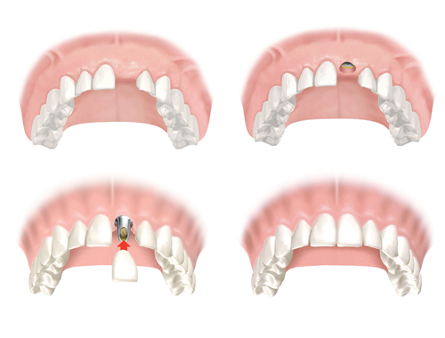 Trồng răng Implant, nha khoa đông nam, răng sứ