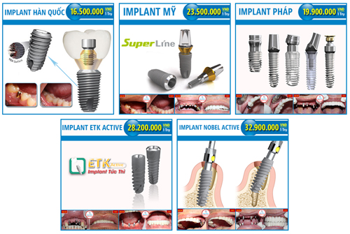 Trồng răng Implant, nha khoa đông nam, răng sứ