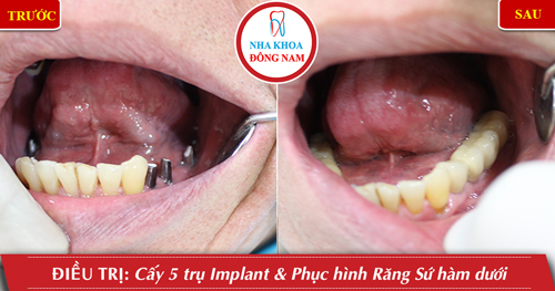 Trồng răng Implant, nha khoa đông nam, răng sứ