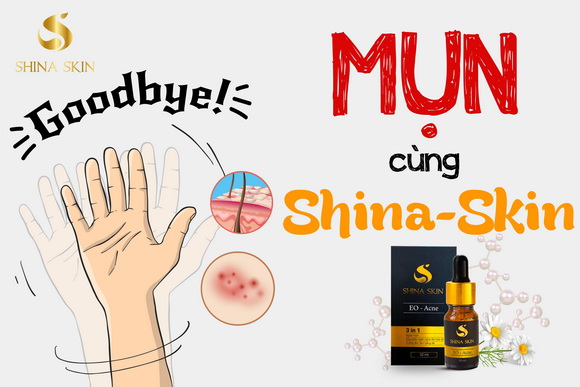 Shina Skin, serum trị mụn, trị mụn EO-Acne