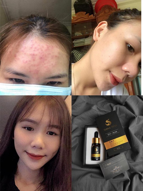 Shina Skin, serum trị mụn, trị mụn EO-Acne