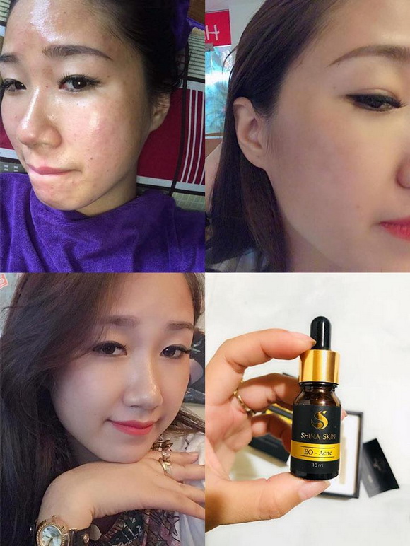 Shina Skin, serum trị mụn, trị mụn EO-Acne