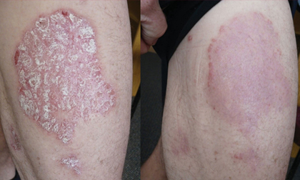 vảy nến thể mảng, điều trị vảy nến, phòng khám Dr. Michaels Psoriasis & Skin Clinic