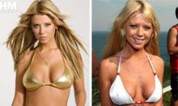 Hậu quả khôn lường của sao khi phẫu thuật nâng ngực