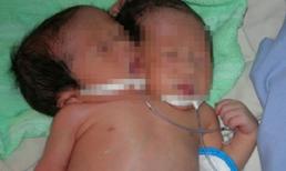 Sóc Trăng: Bé gái sơ sinh có hai đầu, ba tay