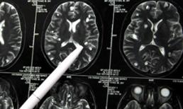 Lên cơn co giật, động kinh vì sán “làm tổ” trong não