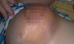 Nâng ngực dạo, silicon 'lổn nhổn' trên cơ thể 