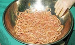 Bé 34 tháng chứa 0,5kg giun trong bụng