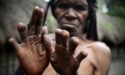 Kinh dị tục lệ chặt ngón tay khi người thân mất 