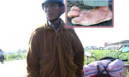 Người đàn ông có bàn bàn chân khổng lồ ở Phú Yên