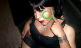 Hậu quả 'kinh dị' vì phẫu thuật thẩm mỹ 