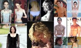 10 câu chuyện kinh hoàng vì biếng ăn