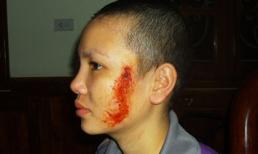 Lời kể của 2 chị em cô gái bị xăm mặt 