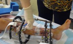 Rùng mình trước hậu quả của phẫu thuật kéo dài chân