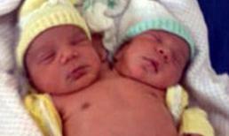 Em bé hai đầu ở Braxin