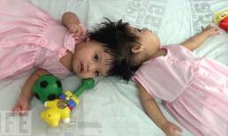 Những cặp sinh đôi dính liền kì lạ nhất 