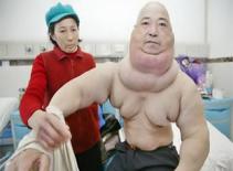 Những người Trung Quốc có khối u bướu... bất thường