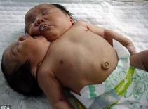 Cặp song sinh hai đầu ở Trung Quốc